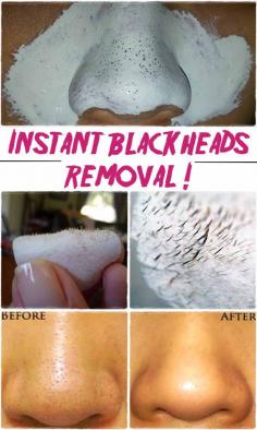 1.SAY GOODBYE BLACKHEADS IN 15 MINUTES !