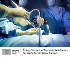 Get rid of overweight with Tasmania Anti-Obesity Surgery’s gastric sleeve surgery. It is a stapling procedure in which 80% of stomach is removed that will not put back into the body again. 