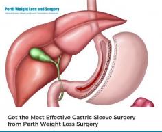Get irreversible Gastric Sleeve Surgery from specialists of Perth Weight Loss Surgery. This procedure is recommended for morbidly obese patients who have body mass index’s greater than 35. 