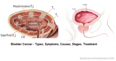 Bladder Cancer - Types, Symptoms, Causes, Stages, Treatment