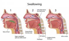 Difficulty swallowing - Sripathi Kethu, M.D.

Dysphagia is the medical term for “difficulty swallowing”. This difficulty can be food not going down easily, pain when swallowing, coughing or gagging while swallowing, feeling as if the food is sticking in the throat or chest, etc. Any kind of difficulty swallowing needs immediate evaluation as it could be a sign of more serious problem. For more details please visit at http://sripathikethumd.com/symptoms/difficulty-swallowing/