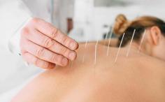 Acupuncture is the external treatment for internal disorders. The treatment is carried out by inserting acupuncture needles at various predetermined points over the body. The term Acupuncture is derived from Latin words acus (needles) and pungere (puncture or prick).