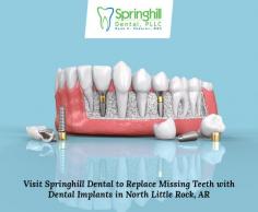Attain a healthy and pleasing smile by replacing all your missing teeth with dental implants from Springhill Dental. Here, Dr. Shearer designs modern implants to fit perfectly on your mouth. 