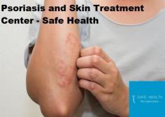 Safe Health Dermatology is a premier medical and cosmetic dermatology center, made of the best dermatologists in Mt. Pleasant. We have one of the most advanced clinics in the region, offering a wide range of psoriasis treatments. For more information, visit our website. 