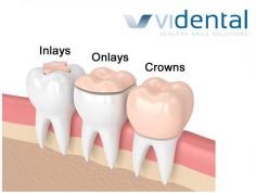 Inlays and onlays can be made of porcelain, gold, or composite resin. These pieces are bonded to the damaged area of the tooth. An inlay, which is similar to a filling, is used inside the cusp tips of the tooth. An onlay is a more substantial reconstruction, similar to the inlay but extending out over one or more of the cusps of the tooth.
