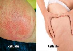Plan your Cellulitis Treatment with our Dermatologist in Lansing and Mount Pleasant. Consult Our Cellulitis Specialist for his Expert Diagnosis & Treatment. Cellulitis is a skin infection characterized by redness, swelling, and pain. For more information, Visit our website. 