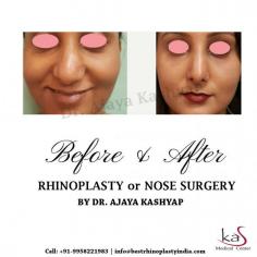 Are you worried about the shape of your nose and if you are thinking about rhinoplasty surgery, then you can consult Dr. Ajaya Kashyap who is a US board certified surgeon.
Contact Dr. Kashyap Clinic (KAS Medical Center) at +91-9958221983, 9958221982 to book a consultation or ask us a question.
#rhinoplasty #nosesurgery #nosejob #nosereshaping #clinic #delhi #india #cosmeticsurgery #plasticsurgeon
