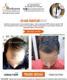 FUE HAIR TRANSPLANT IN DEHI- BEST DERMATOLOGIST IN DELHI- DR. SURUCHI PURI
✨ Meet one of our Esteemed Patients✨   
✔️ Concern : Baldness 
✔️ Treatment : FUE Hair transplant & PRP Sessions 
Another noteworthy transformation via PRP Sessions & few Grafts Hair Transplant by DR. SURUCHI PURI 
Note - These results are post 4-5 months, Usually, it takes 9-10 months for full results in hair transplant.
The client is very happy & Satisfied with the Results
