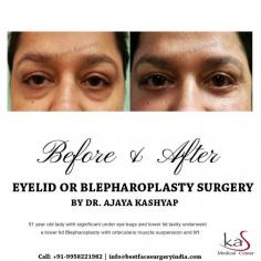 Lower blepharoplasty also known as lower eyelid surgery is a procedure to improve the sagging, baggy, or wrinkles of the undereye area.
Get the best Cosmetic and Plastic surgery in India at KAS Medical Center. For any kind of enquire about, lower eyelid surgery please complete our contact form or call +91-9818963662 or +91-9958221983.
Email: info@bestfacesurgeryindia.com
Web: www.bestfacesurgeryindia.com
Youtube: https://www.youtube.com/watch?v=7bMfIPudy1g

#Eyelid #loweeyelid #lowerblepharoplasty #eyebags #beforeandafter #DrKashyap #CosmeticSurgery #PlasticSurgeon #Delhi #India

