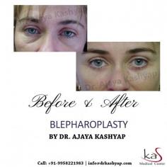 Eyelid surgery (also called an eyelid lift or blepharoplasty) tightens and lifts sagging skin around the eye area. It can be done on upper lids to raise hooded or droopy eyelids. It’s also performed on lower lids to remove bags and tighten loose skin. 

Book an Appointment: www.drkashyap.com

Whatsapp: https://api.whatsapp.com/send?phone=919289988888

#Eyelid #lowereyelid #lowerblepharoplasty #eyebags #beforeandafter #DrKashyap #CosmeticSurgery #PlasticSurgeon #Delhi #India
