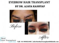 Need Eyebrow hair transplant surgery in Delhi, India. Meet Triple American Board Certified surgeon Dr. Ajaya Kashyap.

For any kind of enquire about, hair transplant procedure please call or whatsapp +91-9818963662 or +91-9289988888

https://www.besthairtransplantdelhiindia.com
Send Your Query: info@besthairtransplantdelhiindia.com

#eyebrowtransplant #hairtransplant #hairrestoration #beard #moustache #FUE #FUT #hairlosstreatment #surgeon #Delhi #India
