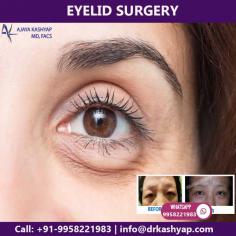 Blepharoplasty is a type of surgery that repairs droopy eyelids and may involve removing excess skin, muscle and fat. For more details and see before & after our national & international patients.
Call now on +91-9958221982 to get instant appointments and take the opportunity to avail knowledgeable consultation of Dr. Ajaya Kashyap 

Email: info@drkashyap.com
Web: www.drkashyap.com

#eyelid #lowereyelid #lowerblepharoplasty #eyebags #beforeandafter #DrKashyap #CosmeticSurgery #PlasticSurgeon #Delhi #India

