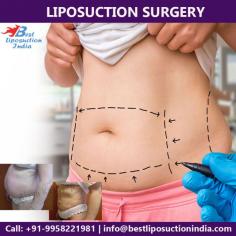 Liposuction is not an overall weight-loss method - it is not a treatment for obesity, but would helpful in removing undesirable deposits of body fat in specific parts of body.
Contact us anytime with any questions you may have, or to schedule your consultation for liposuction cosmetic surgery in Delhi, India. 

Schedule a virtual consultation by:
Phone: 995-822-1981
For Pricing: Text 995-822-1981
Email: info@bestliposuctionindia.com
Website: www.bestliposuctionindia.com
Location: Khasra no 541/542, MG Road, Aya Nagar, Metro Pillar 184, Near the Arjan Garh Metro Station, New Delhi, India
Note: Individual results may vary.⁣

#plasticsurgery #surgery #transformation #vaserlipo #bodyjetlipo #liposuction #tummytuck #breastsurgery
