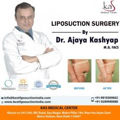 best liposuction surgery in Delhi, Liposuction, liposuction, vaser liposuction, arm liposuction, body jet liposuction, water jet liposuction, buttock liposuction, thigh liposuction, abdomen liposuction, hip liposuction