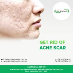 Do you want to get rid of the stubborn acne scars of your skin, and give your skin a natural glowing look? Then,visit #KASMedicalCenter today and get the Acne Scar Treatment done. Contact us today inquire about acne scar treatment cost in Delhi.

Schedule a consultation by:

Dr. Ajaya Kashyap
Email: info@skintreatmentsindia.com
Web: www.skintreatmentsindia.com
Call: +91-9818300892
For Pricing: Text +91-9818300892
Location: Khasra no 541/542, MG Road, Aya Nagar, Metro Pillar 184, Near the Arjan Garh Metro Station, New Delhi, India
#Acne #Scars #AcneScarTreatment #SkinCare #NonSurgical #LoveforSkin

