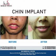 Looking for Best Chin Implant surgery in Delhi, India? We at cosmetic plastic surgery clinic, provide Chin Augmentation Procedure at affordable cost/ price in Delhi, india by top plastic surgeon doctor - Dr. Ajaya Kashyap at KAS Medical Center.
Take Video Consultation with our doctor from the comfort of your home. To book an appointment for Video Consultation Call or Whatsapp: +91-9958221982

CONTACT US:-
Dr. Ajaya Kashyap (MD, FACS)
Mobile: +91-9818369662, 9958221982
Email: info@imageclinic.org
Web: www.imageclinic.org
Location: Khasra no 541/542, MG Road, Aya Nagar, Metro Pillar 184, Near the Arjan Garh Metro Station, New Delhi, India

#chinaugmentation #chinfiller #chinimplant #cosmeticsurgery #plasticsurgeon #chinaugmentationdelhi #chinimplantcostinindia #Drkashyap #Delhi #India #medicaltourism
