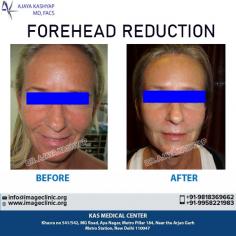 Looking for Best forehead shortening surgery in Delhi, India? We at cosmetic plastic surgery clinic, provide forehead reduction Surgery at affordable cost/ price in Delhi, india by top plastic surgeon doctor - Dr. Ajaya Kashyap at KAS Medical Center.

Schedule a consultation by:

Dr. Ajaya Kashyap
Email: info@imageclinic.org
Web: www.imageclinic.org
Call: +91-9958221981
For Pricing: Text +91-9958221981
Location: Khasra no 541/542, MG Road, Aya Nagar, Metro Pillar 184, Near the Arjan Garh Metro Station, New Delhi, India

#foreheadshortening #foreheadreduction #facesurgeon #realpatient #beauty #realself #plasticsurgeon #cosmeticsurgery #drkashyap #delhi #india
