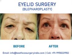 Eyelid surgery (also called an eyelid lift or blepharoplasty) tightens and lifts sagging skin around the eye area. It can be done on upper lids to raise hooded or droopy eyelids. It’s also performed on lower lids to remove bags and tighten loose skin. Blepharoplasty Procedure at affordable cost/ price in Delhi, india by US board certified surgeon - Dr. Ajaya Kashyap at KAS Medical Center.

Take Video Consultation with our doctor from the comfort of your home. To book an appointment for Video Consultation Call or Whatsapp: +91-9958221982

Schedule a consultation by:
Dr. Ajaya Kashyap
Call or Whatsapp: +91-9958221982
Email: info@bestfacesurgeryindia.com
Web: www.bestfacesurgeryindia.com
Location: Khasra no 541/542, MG Road, Aya Nagar, Metro Pillar 184, Near the Arjan Garh Metro Station, New Delhi, India

#blepharoplasty #lowereyelid #uppereyelid #eyelidsurgery #cosmeticsurgery #plasticsurgeon #Delhi #India
