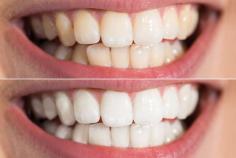 Teeth Whitening in the Virgin Islands
At VI Dental Center, our team is prepared to answer all questions about teeth whitening. Oral hygiene, specifically brushing and flossing, are a vital part of your dental health. We can also answer your questions about the different dental specialties and explain the meaning of dental terms.