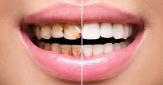 Dental Veneers: How Can They Offer You Beautiful Smile?