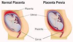 Visit Us: https://askashika.com/endometrial-issues/
Endometrial Issues- Placenta Previa, Anterior, Posterior Placenta
Having Endometrial Issues? Get the best treatment in Tirunelveli from the hospital for endometrium thickened, placenta previa and all placenta problems.
