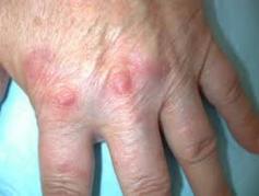 Granuloma annulare is very comparable the same to psoriasis in that together is incendiary immune system matter of the skin. We utilize the Natural Remedies for Granuloma Annulare and the skin detox method for Natural Treatment for Granuloma Annulare .
