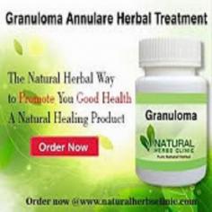Granuloma annulare is very comparable the same to psoriasis in that together is incendiary immune system matter of the skin. We utilize the Natural Remedies for Granuloma Annulare and the skin detox method for Natural Treatment for Granuloma Annulare.
