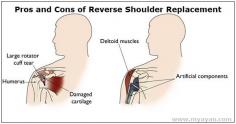 Pros and cons of reverse shoulder replacement surgery. The risks and benefits of this surgery should be discussed carefully with your doctor before deciding