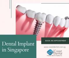 If you are looking for a permanent solution for your missing teeth, dental implants are your best option. Dental implants in Singapore are surgically inserted into the jawbone, adding strength to the jawbone and is typically made of titanium. Dental implants in Singapore are considered the best alternative to dental bridges. So how long can you expect the entire procedure and recovery? The whole process can take up to a maximum of 6 months; it is best to get the consultation from your dentist in Singapore regarding the schedule as every patient differs and your dentist can advise you precisely of the procedure that will be followed. Book an appointment with Coast Dental Clinic at Katong now to learn more about Dental Implants in Singapore.