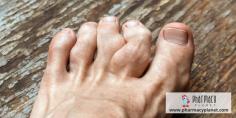Gout is a common and complex form of arthritis characterised by severe pain, redness and tenderness in joints. Read our latest blog post to know some easy ways to Deal with a Painful Gout Attack.