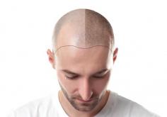 Hair Transplantation is one of the popular procedure done to enhance the facial aesthetics. Hair Restoration today is a minimally invasive procedure that creates real, natural-looking results using your own hair follicles. At FMS Skin & Hair Clinics Hair Transplantation is not only a promising procedure for Male Pattern Baldness and female Pattern Alopecia.

https://www.fmsskin.com/best-hair-transplant-clinic-in-hyderabad/