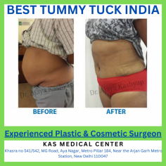 If you have more than excess fat that is troubling you about your abdomen, waist, sides and back that you can't get rid of then #tummytuck surgery can help you and improve your body texture and confidence.
For more information about #abdominoplasty surgery, or to schedule a consultation, please call KAS Medical Center today at +91-9958221983 or use our online appointment request form :
website : www.besttummytuckindia.com
Email : info@besttummytuckindia.com
