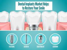 A dental implant is a surgical component that interfaces with the bone of the jaw or skull to support a dental prosthesis such as a crown, bridge, denture, facial prosthesis or to act as an orthodontic anchor. Basically, they are artificial tooth roots that are used to support false teeth or bridges. They are made of titanium and/or other materials, which are compatible with the human body. They are substitute missing teeth and are placed in the jaw to support restorations.

https://www.bharatbook.com/blog/dental-implants-market-helps-to-restore-your-smile

