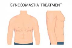 Thing you need to know about Gynecomastia Surgery – Stages, costs and types

Instant medical loan service in Mumbai for gynecomastia surgery
While going for gynecomastia surgery, you can take an instant medical loan in Mumbai. GMoney offers medical assistance finance to help you pay for your medical emergencies. You can pay for your medical bills with this loan for all types of medical-related services. For example, you can use the funds for paying all types of surgeries, doctor fees, dental treatments, cosmetic surgeries, liposuction, IVF treatment, medical bills, diagnostic expenses, hospital bills, etc.
GMoney is a known medical loan financer in Mumbai, where you can apply online and get funds in minutes. This loan is easy to apply for and can be repaid in zero-cost EMI with a tenure ranging from 3 to 18 months. 
Conclusion
The feeling of a heavy male breast can disrupt your self-esteem. It may put you in an embarrassing position sometimes. In these situations, you can undergo gynecomastia surgery with the help of medical finance assistance from GMoney. 
https://www.gmoney.in/mumbai/