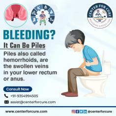 Center For Cure is the leading center for the best piles laser treatment in Delhi NCR. Our experienced team of experts provides the most advanced and safe laser therapy for piles. Get rid of piles now!