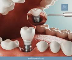 When it comes to tooth replacement options, dental implants have revolutionized the field of dentistry. If you're seeking a reliable and advanced solution to restore your missing teeth in Surrey, look no further than Post House Dental. With their expertise and state-of-the-art technology.

Looking for dental implants in Surrey? Look no further than Post House Dental! Here are the benefits you can enjoy:

Enhanced Smile: Dental implants at Post House Dental are designed to blend seamlessly with your natural teeth, giving you a beautiful and confident smile.

Improved Functionality: With dental implants, you can enjoy the freedom to eat your favorite foods without worry. They provide stability and durability, just like real teeth.

Long-Term Solution: Dental implants offered by Post House Dental are a long-lasting option for tooth replacement. With proper care, they can last for many years, making them a worthwhile investment.

Preserved Oral Health: Unlike traditional bridges, dental implants don't require the alteration of adjacent teeth. This helps maintain the integrity of your natural teeth and promotes overall oral health.

Convenience and Comfort: Dental implants eliminate the hassle of removable dentures. You won't have to worry about slippage or discomfort. They become a permanent part of your mouth, allowing for easy maintenance and cleaning.

Choose Post House Dental in Surrey for reliable dental implants that will enhance your smile and improve your oral health. Schedule your consultation today!