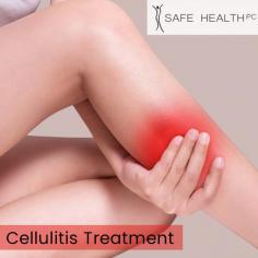 Receive expert care and effective treatment for skin infections with a dedicated Cellulitis Specialist in Lansing. Trust their expertise to provide specialized care and guidance, ensuring optimal outcomes and healing for your skin condition. Visit us today to schedule an appointment with our Cellulitis Specialist.
