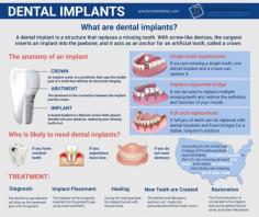 Adult tooth loss is very common, particularly as we get older. Rather than dealing with the pain and inconvenience of dentures, Precision Dental offers a more natural solution in the form of dental implants in Astoria.

Dental implants can replace one or more missing or damaged teeth with a permanent solution that leaves your smile looking 100% natural and allows you to eat the foods you love again – in as little as one day. So why wait any longer to regain your smile and self-confidence?

About Dental Implants
Precision Dental NYC will provide you with high-quality, affordable dental implants that will make your teeth healthier than they were before. Furthermore, your new teeth may also improve your appearance. Your family dentist will provide you with affordable dental implant options. You’ll be able to speak, smile, and chew as well as you did before with the right kind of teeth implants. As a result, the bones become stronger.

Nearly three million people in the United States profit from the latest dental materials and techniques, making low-cost dental implants common.

“Today, implants with attached crowns are the preferred method for treating tooth loss because they function the same as natural teeth and help preserve the jaw structure by preventing atrophy from bone loss.

Bridgework and dentures address the cosmetic problem of missing teeth but do not prevent bone loss. Permanent implants maintain proper chewing function and exert appropriate, natural forces on the jaw bone to keep it functional and healthy,” reports the American Academy of Implant Dentistry.

According to AAID statistics, dental implant cost doesn’t deter the popularity either, as about 500,000 Americans get new implants yearly. Seek out your cosmetic dentist to learn your eligibility for getting the best dental implants.

Contact us today to schedule an appointment if you’re interested in dental implants. We’ll go through your dental background, criteria, and issues with you, as well as all of your care options. Call today to learn more about implants as a viable solution for an inconvenient prosthesis.

Read more about dental implants here: https://precisiondentalnyc.com/dental-implants/

Precision Dental NYC
21-34 30th Ave,
Queens, NY 11102
(718) 274-2749
Web Address https://precisiondentalnyc.com
https://precisiondentalnyc.business.site/
E-mail info@precisiondentalnyc.com

Our location on the map: https://g.page/Precision-Dental-NYC

Nearby Locations:
Astoria | Ditmars Steinway | Astoria Heights | Jackson Heights | Woodside | Sunnyside Gardens | Dutch Kills
11101, 11102, 11103, 11104, 11105, 11106 | 11372 | 11377

Working Hours :
Monday: 9AM-7PM
Tuesday: 9AM-7PM
Wednesday: Closed
Thursday: 9AM-7PM
Friday: Closed
Saturday: 9AM-4PM
Sunday: Closed

Payment: cash, check, credit cards.