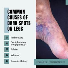 Dark spots can appear on your legs for several reasons. For many people, these spots are a cosmetic issue, but persistent brown and black spots or discoloration on the legs accompanied by other symptoms can be a sign of some underlying medical condition. At the Vein Care Center, top vein doctor Jonathan Arad will evaluate the dark spots on your legs and diagnose what is causing them. He will recommend professional treatment, including laser therapy to get your skin back to its original tone.

Dark spots on legs or skin discoloration can occur for a variety of reasons. Some of these causes are temporary and go away with time on their own. Others may require medical intervention and long-term treatment to clear up.

Dark spots on both legs often result from a skin condition that indicates poor circulation or some underlying metabolic issue. Visit a doctor if you are concerned about persistent dark spots on your legs and ankles and want to know about their possible causes and treatment options.

In most cases, these dark spots are nothing to worry about and fade away with time, but you must have your legs examined by an expert physician to ensure they do not indicate any serious problem.

Read more: https://www.veincarecenter.com/what-causes-dark-spots-on-your-legs-and-how-treat-them/

Vein Care Center
41 5th Ave, 1ABV
New York, NY 10003
(212) 242-8164

140 NJ-17, Suite 101V
Paramus, NJ 07652
(201) 849-5135
Web Address https://www.veincarecenter.com/
https://veincarecenterny.business.site/
E-mail info@veincarecenter.com 

Our locations on the map:
New York https://goo.gl/maps/9e98FWGeqCk1t5CQ9
Paramus https://goo.gl/maps/vGCA3hrGkghjZLDV6

Nearby Locations:
New York
Union Square | Peter Cooper Village | Ukrainian Village | Noho | Greenwich Village
10003 | 10009, 10010 | 10012 | 10014

Nearby Locations:
Paramus
Paramus | River Edge | Maywood | Rochelle Park | Saddle Brook | Arcola
07652 | 07646, 07661 | 07662 | 07663 | 07670

Working Hours:
Monday-Friday: 9am–6pm

Payment: cash, check, credit cards.