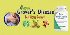 In this article, we, as experts in the field, will delve into the intricacies of Grover's Disease management through diet, natural treatments, herbal remedies, and holistic approaches to alleviate the symptoms and promote overall well-being.
