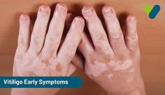 Are you worried that you might have vitiligo? Check out this blog for the 3 most common signs and symptoms of vitiligo. Visit Livlong for more information about early signs of vitiligo.