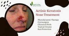 While actinic keratosis can ultimately lead to skin cancer, treatment options are available to prevent further damage and remove the lesions. In this blog, we will provide an overview of the latest advances in Actinic Keratosis Nose Treatment.
