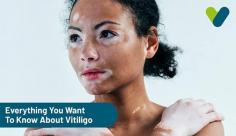 Check out our comprehensive overview of Vitiligo illness, which causes loss of skin pigment in patches, including symptoms, causes, treatment, and kinds. Learn more about Vitiligo at Livlong now!