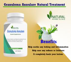 Proper Self-Care for Granuloma Annulare can be possible to ease the symptoms and keep the condition under control. Self-care can be anything from simple lifestyle changes to more extensive treatment plans.
