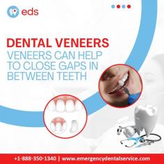 Dental Veneers | Emergency Dental Service

Smile confidently with Dental Veneers!  Say goodbye to gaps between your teeth and hello to a flawless smile!  Achieve a natural-looking, seamless result with Emergency Dental Service. Schedule an appointment at 1-888-350-1340. 