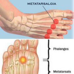Orthotics For Metatarsalgia are a type of shoe insert that can help to correct foot alignment and relieve pain. Boynerclinic.com offers orthotics for metatarsalgia, a condition that affects the ball of the foot. Check out our site for more details.
visit us: https://boynerclinic.com/metatarsalgia/

