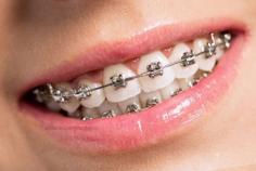 What are Braces?
Braces are dental appliances that aid in the correction of dental issues such as crowding, crooked teeth, or teeth that are out of alignment. It can also be used to improve your smile. Many people get braces in their teens, but adults can get them too. Braces gradually straighten and align your teeth so that you have a normal bite as you wear them.