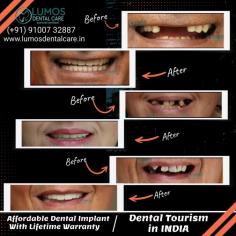 Looking for affordable dental implant options in Hyderabad, India? Look no further than Lumos Dental Care.
We offer cheap dental implants without compromising on quality or patient
care.
