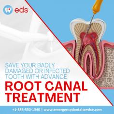 Root Canal Treatment | Emergency Dental Service

When a tooth is badly damaged or infected, root canal treatment can be a lifesaver. You can save your tooth and avoid extraction with Advance Root Canal Treatment. Our skilled dentists employ cutting-edge methods to provide a painless process. Don't suffer in silence—call Emergency Dental Service today to save your teeth! Schedule an appointment at 1-888-350-1340.